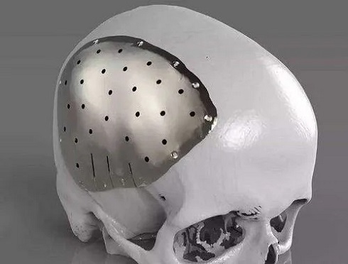 Titanium cranium