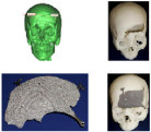 Titanium 3D printed craniomaxillofacial prosthesis